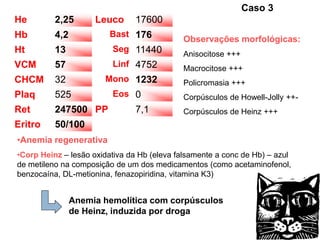 Caso 3
He        2,25       Leuco     17600
Hb        4,2            Bast 176
                                            Observações morfológicas:
Ht        13             Seg 11440
                                            Anisocitose +++
VCM       57             Linf 4752          Macrocitose +++
CHCM      32           Mono 1232            Policromasia +++
Plaq      525            Eos 0              Corpúsculos de Howell-Jolly ++-
Ret       247500 PP            7,1          Corpúsculos de Heinz +++
Eritro    50/100
•Anemia regenerativa
•Corp Heinz – lesão oxidativa da Hb (eleva falsamente a conc de Hb) – azul
de metileno na composição de um dos medicamentos (como acetaminofenol,
benzocaína, DL-metionina, fenazopiridina, vitamina K3)


                Anemia hemolítica com corpúsculos
                de Heinz, induzida por droga
 