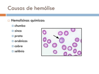 Causas de hemólise
   Hemolisinas químicas:
     chumbo

     zinco

     prata

     arsênicos

     cobre

     selênio
 