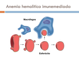 Anemia hemolítica imunemediada

        Macrófagos




                     Esferócito
 