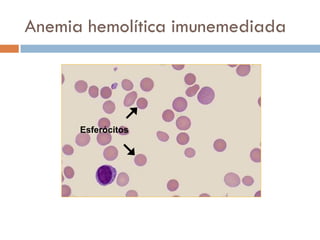 Anemia hemolítica imunemediada




      Esferócitos
 