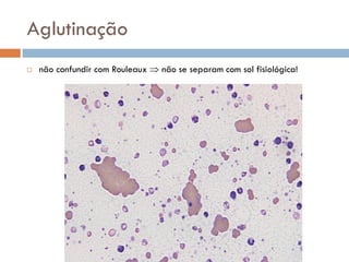 Aglutinação
   não confundir com Rouleaux  não se separam com sol fisiológica!
 