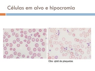Células em alvo e hipocromia




                 Obs: qtdd de plaquetas
 