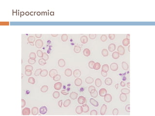 Hipocromia
 