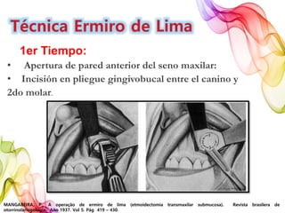 MANGABEIRA, P., A operação de ermiro de lima (etmoidectomia transmaxilar submucosa). Revista brasilera de
otorrinolaringología. Año 1937. Vol 5. Pág 419 – 430.
1er Tiempo:
• Apertura de pared anterior del seno maxilar:
• Incisión en pliegue gingivobucal entre el canino y
2do molar.
 