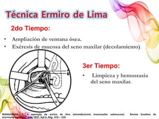 MANGABEIRA, P., A operação de ermiro de lima (etmoidectomia transmaxilar submucosa). Revista brasilera de
otorrinolaringología. Año 1937. Vol 5. Pág 419 – 430.
2do Tiempo:
• Ampliación de ventana ósea.
• Exéresis de mucosa del seno maxilar (decolamiento).
3er Tiempo:
• Limpieza y hemostasia
del seno maxilar.
 