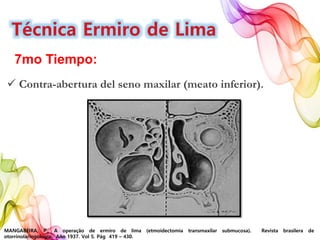 MANGABEIRA, P., A operação de ermiro de lima (etmoidectomia transmaxilar submucosa). Revista brasilera de
otorrinolaringología. Año 1937. Vol 5. Pág 419 – 430.
7mo Tiempo:
 Contra-abertura del seno maxilar (meato inferior).
 