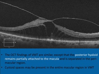 Vmt Classification Epiretinal membrane and vitreomacula traction in updates by Panit ...