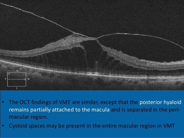 Epiretinal Membrane And Vitreomacula Traction In Updates By Panit Che Epiretinal Membrane And Vitreomacula Traction In Updates By Panit Che