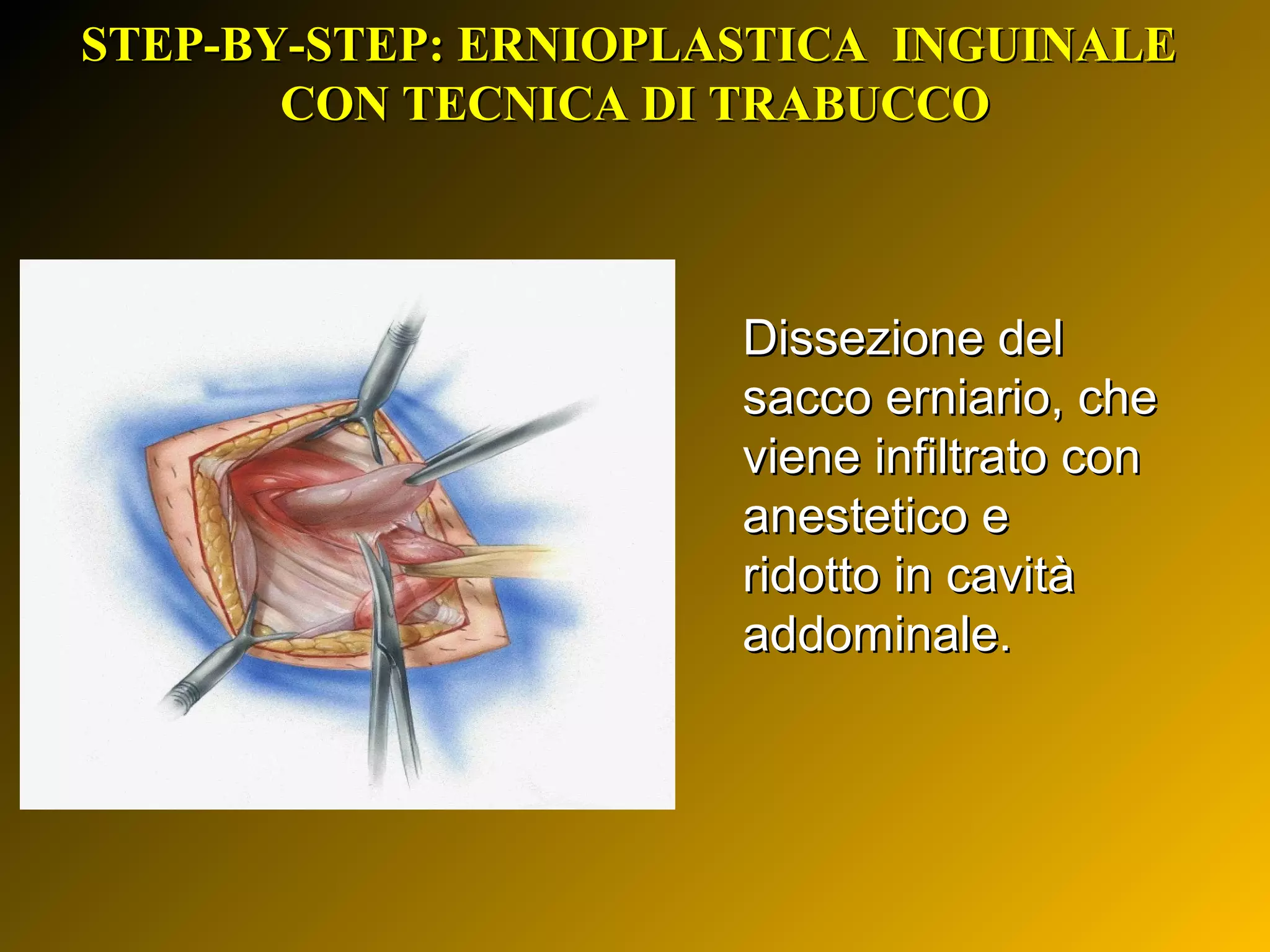 Cos'è un'ernia inguinale? Storia ed attualità della terapia chirurgica ...