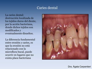Caries dentalLa caries dental: destrucción localizada de los tejidos duros del diente, por la acción bacteriana, donde dichos tejidos son modificados y eventualmente disueltos.La diferencia fundamental entre erosión y caries, es que la erosión no está relacionado con la microflora bucal, puede ocurrir en lugares que no exista placa bacterianaDra. Ágata Carpentieri