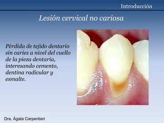 IntroducciónLesión cervical no cariosaPérdida de tejido dentario sin caries a nivel del cuello de la pieza dentaria,interesando cemento, dentina radicular yesmalte.Dra. Ágata Carpentieri