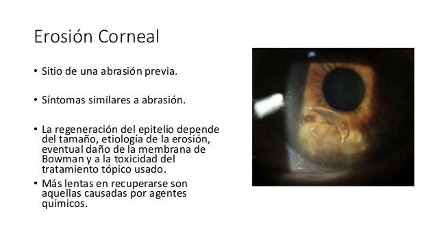 síntomas recurrentes de diabetes por erosión corneal