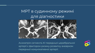 МРТ в судинному режимі
для діагностики
Асиметрія сегмента А1 передньої церебральної
артерії є фактором ризику розвитку аневризм
передньої комунікативної артерії.
 