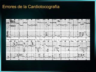 Errores de la Cardiotocografía