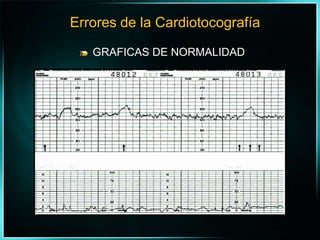 GRAFICAS DE NORMALIDADErrores de la Cardiotocografía