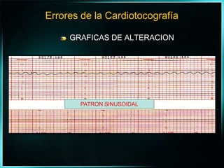 GRAFICAS DE ALTERACIONErrores de la CardiotocografíaPATRON SINUSOIDAL