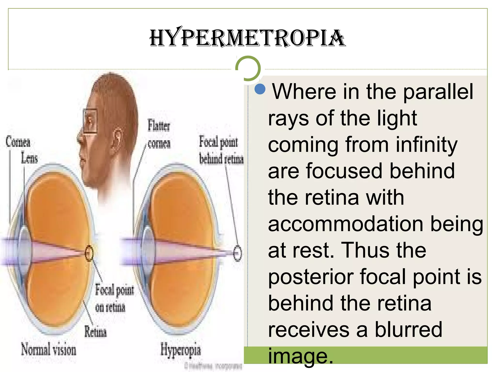 hypermetropia
Where in the parallel
rays of the light
coming from infinity
are focused behind
the retina with
accommodation being
at rest. Thus the
posterior focal point is
behind the retina
receives a blurred
image.
 