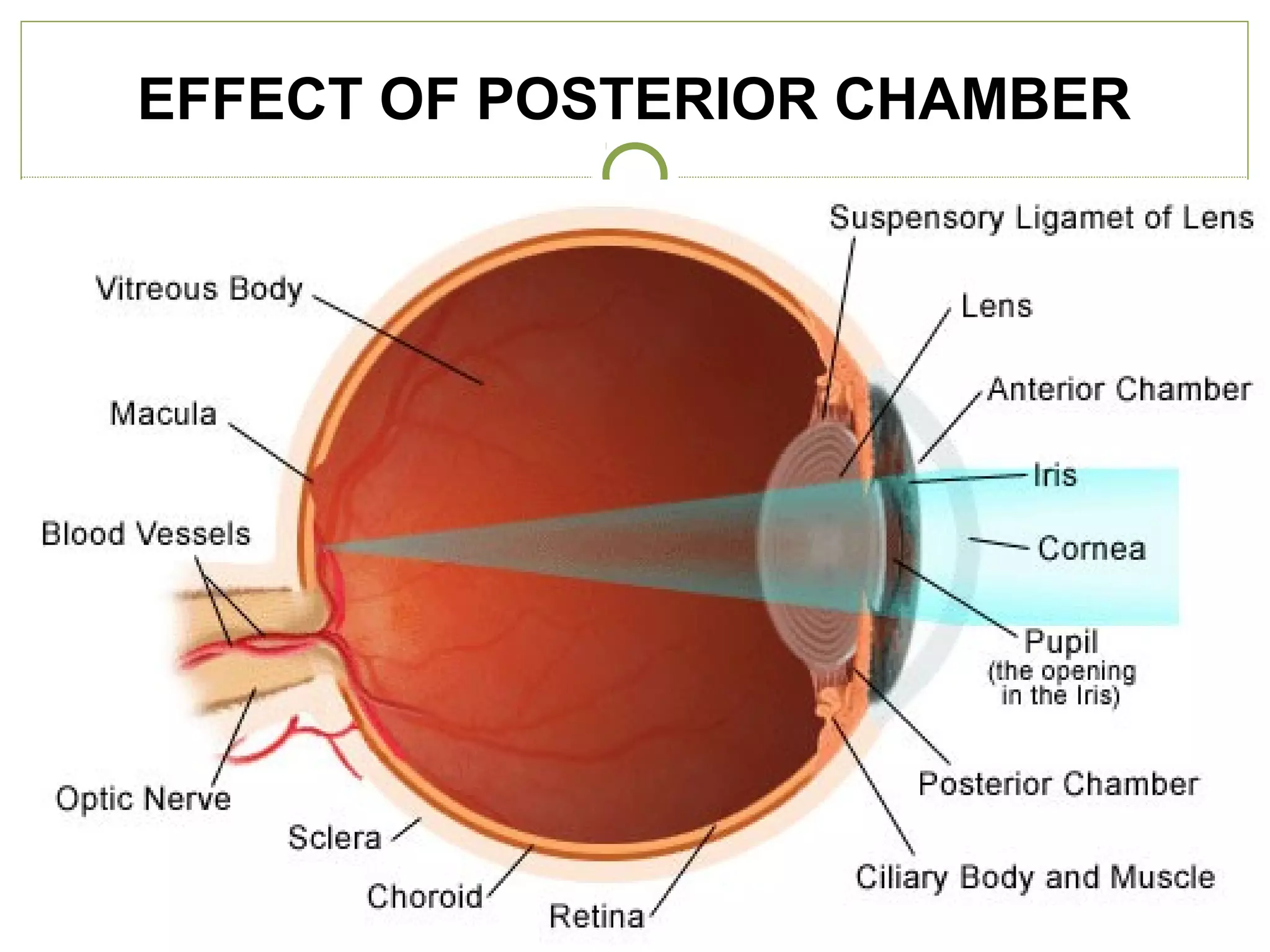 EFFECT OF POSTERIOR CHAMBER
 