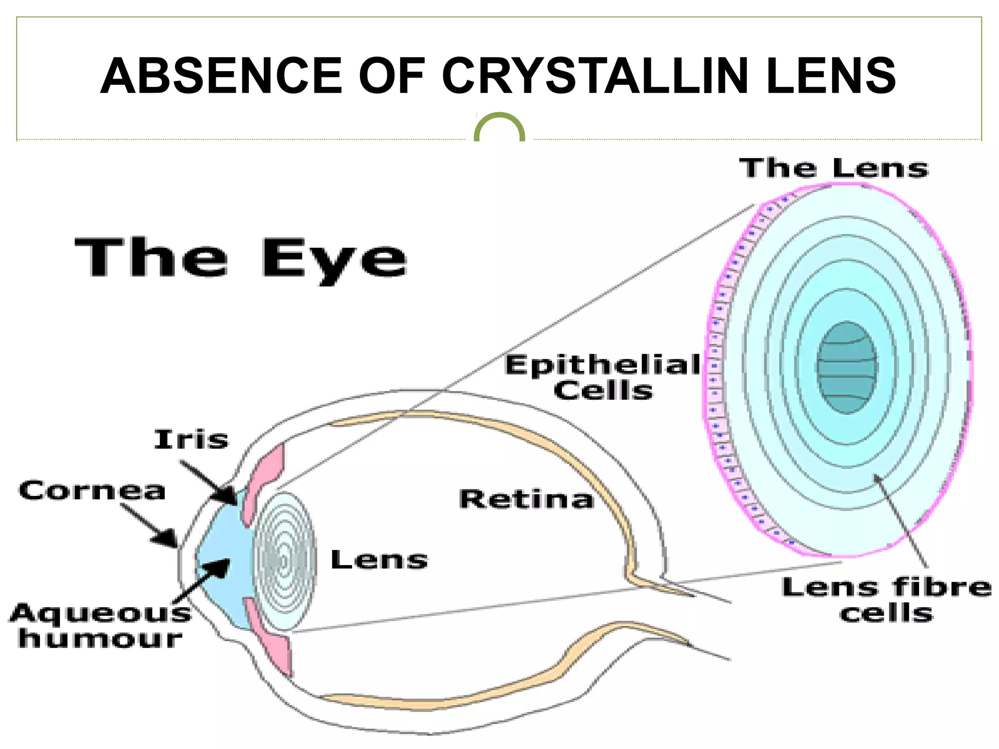 ABSENCE OF CRYSTALLIN LENS
 