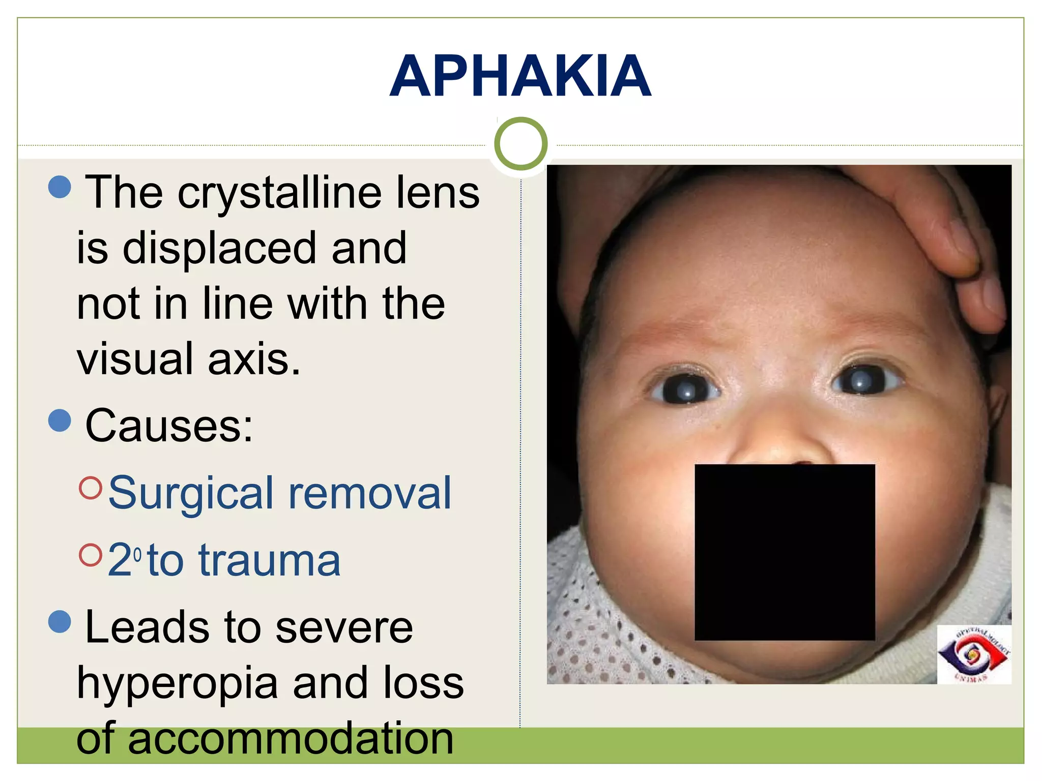 APHAKIA
The crystalline lens
is displaced and
not in line with the
visual axis.
Causes:
Surgical removal
2o
to trauma
Leads to severe
hyperopia and loss
of accommodation
 