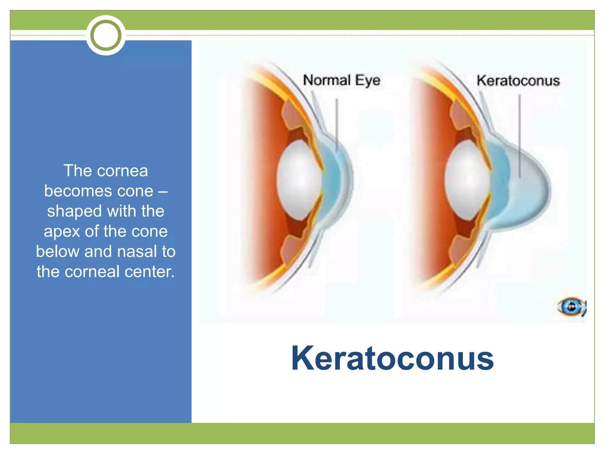 Keratoconus
The cornea
becomes cone –
shaped with the
apex of the cone
below and nasal to
the corneal center.
 