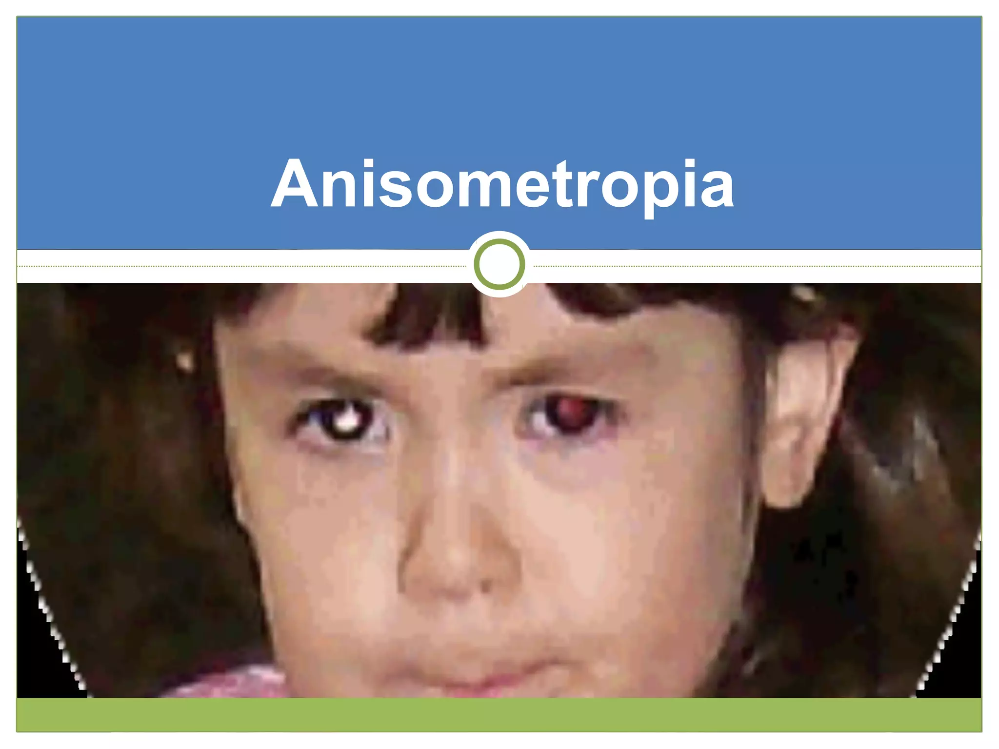 Anisometropia
 