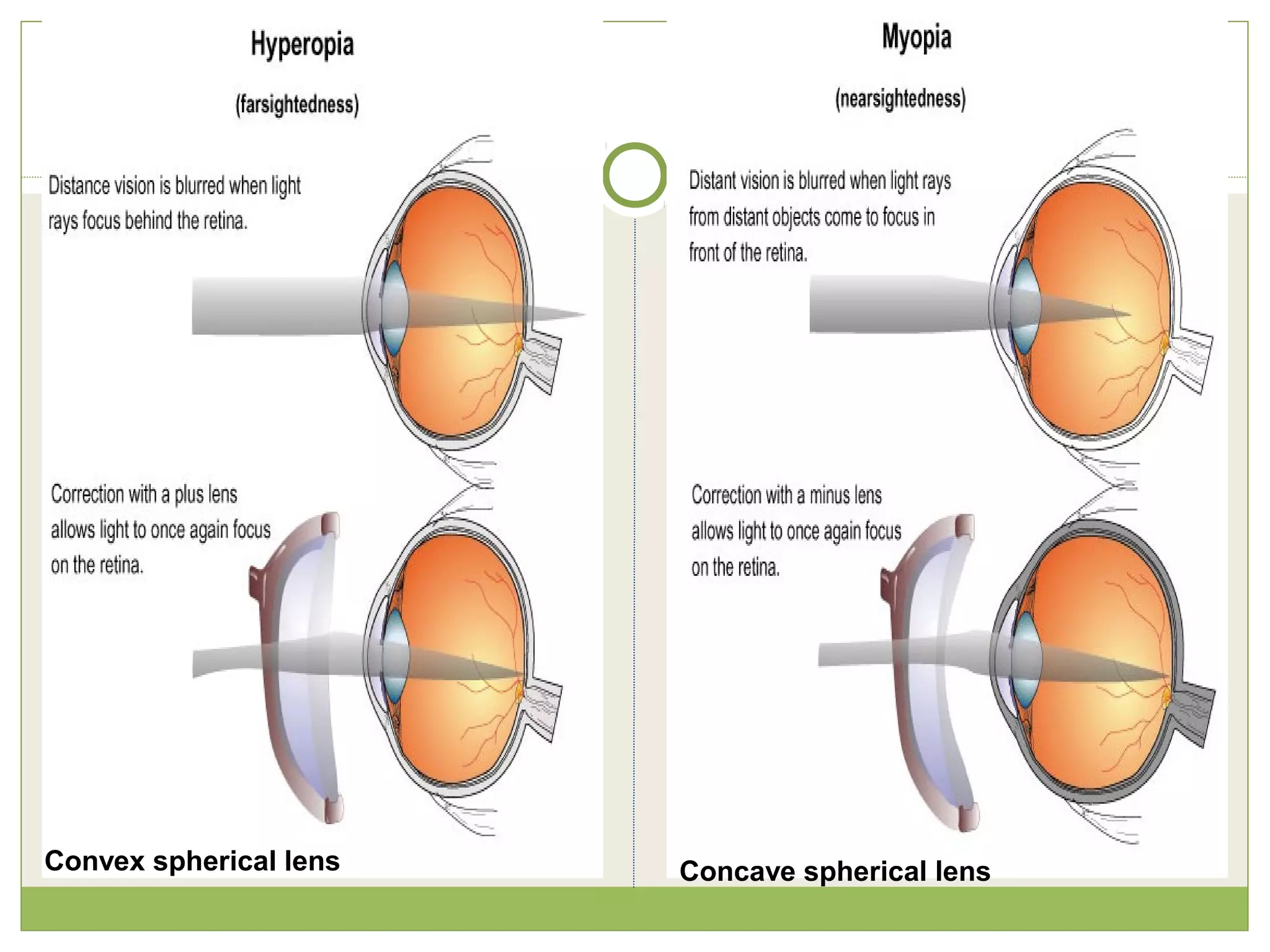 Concave spherical lensConvex spherical lens
 