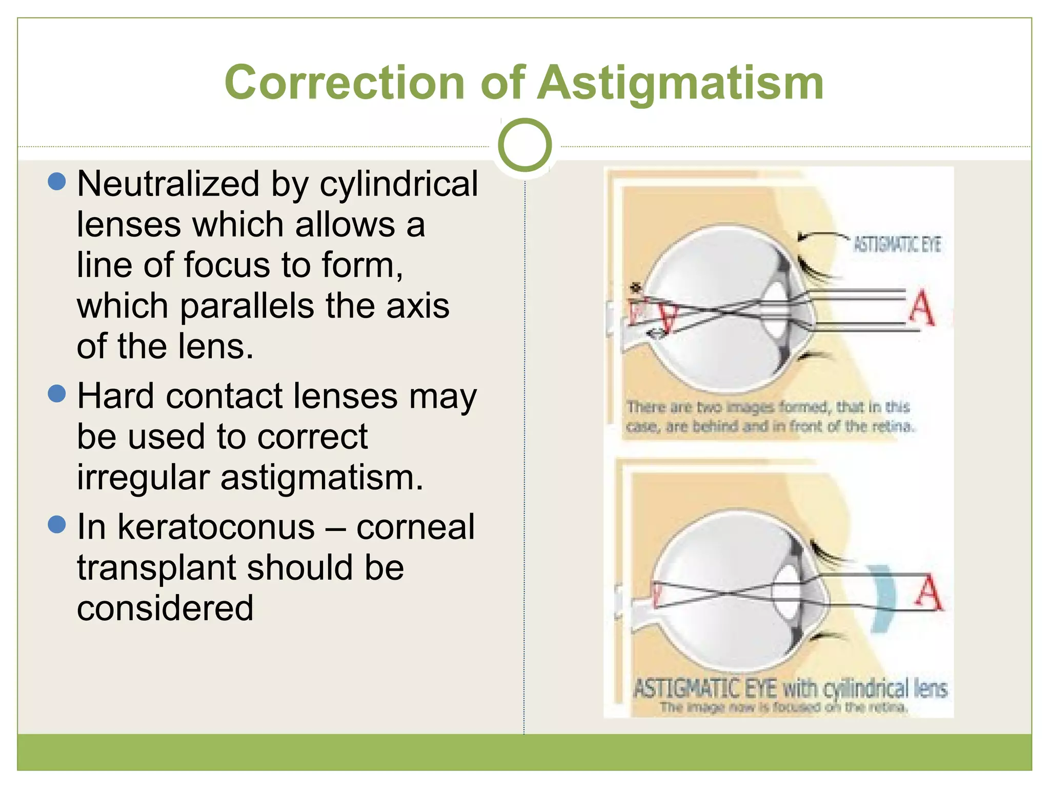 Neutralized by cylindrical
lenses which allows a
line of focus to form,
which parallels the axis
of the lens.
Hard contact lenses may
be used to correct
irregular astigmatism.
In keratoconus – corneal
transplant should be
considered
Correction of Astigmatism
 