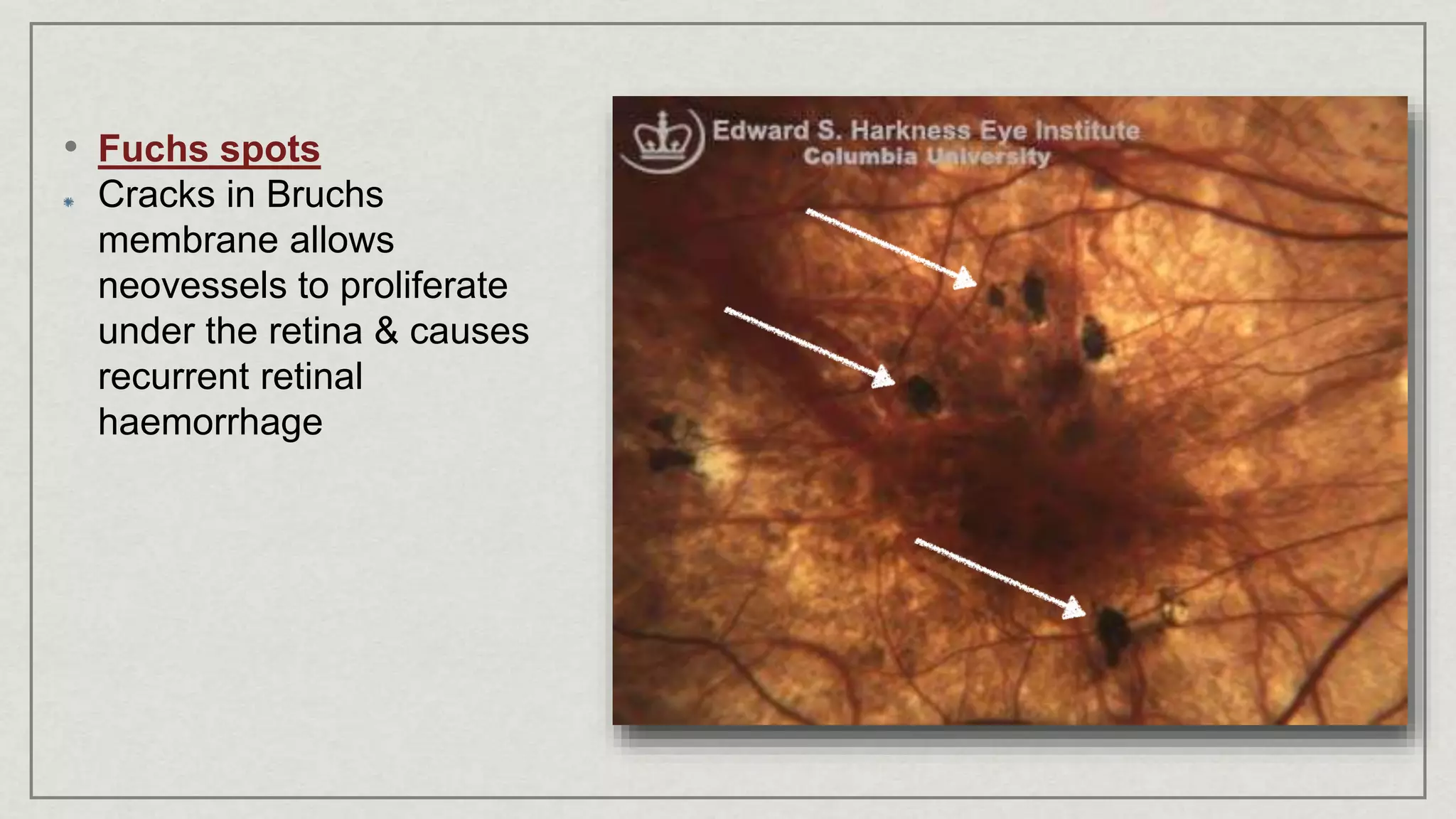 • Fuchs spots
Cracks in Bruchs
membrane allows
neovessels to proliferate
under the retina & causes
recurrent retinal
haemorrhage
 