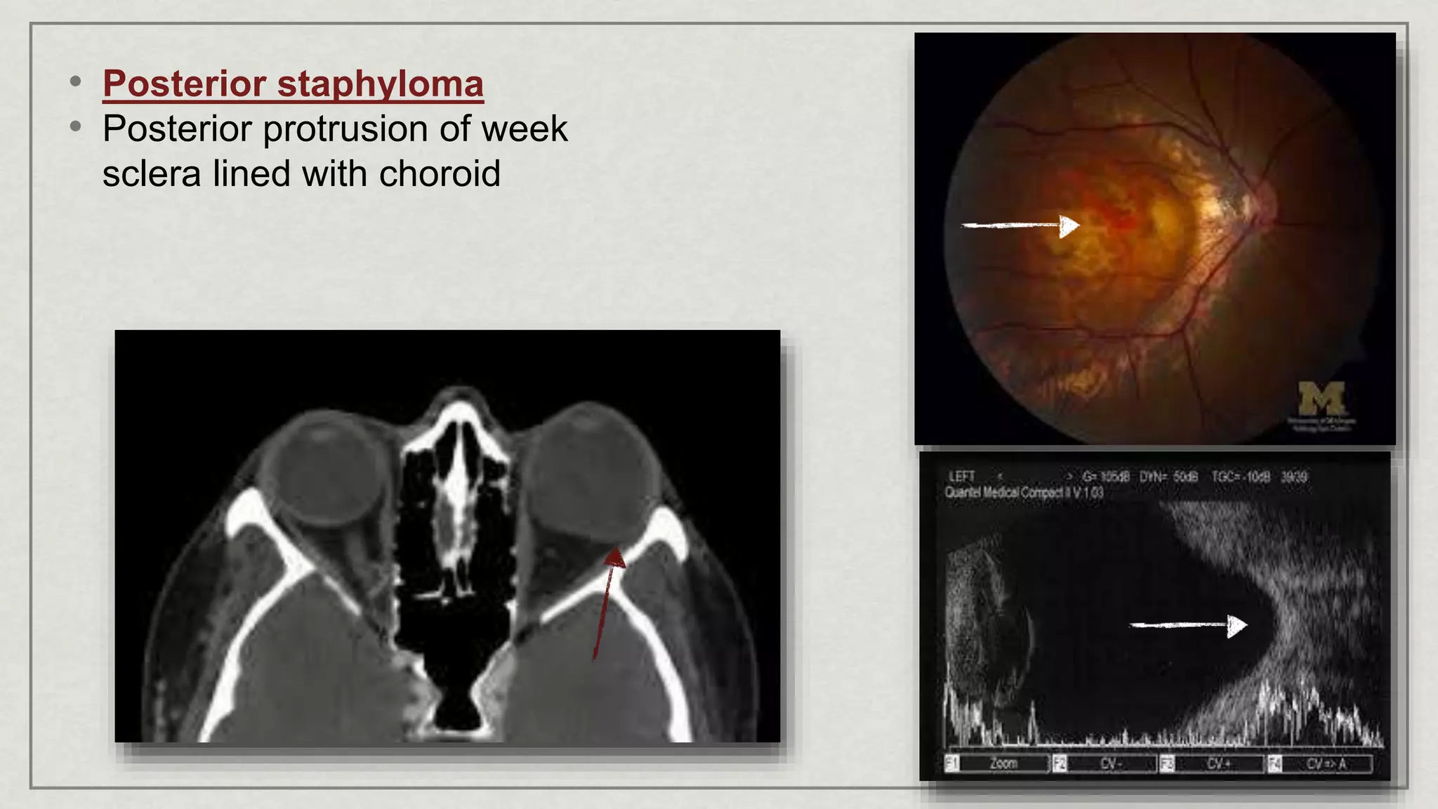 • Posterior staphyloma
• Posterior protrusion of week
sclera lined with choroid
 