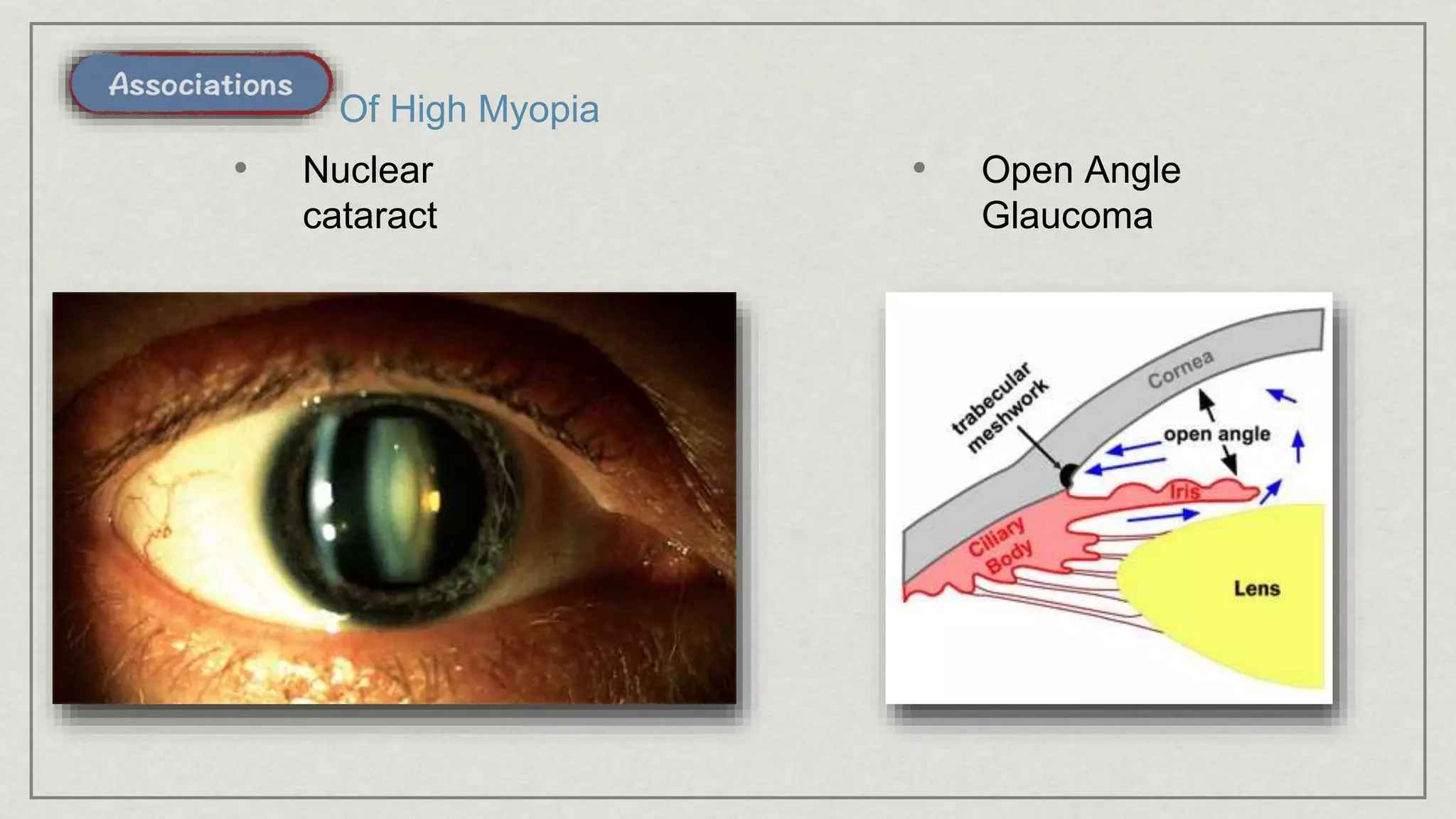 • Nuclear
cataract
Of High Myopia
• Open Angle
Glaucoma
 