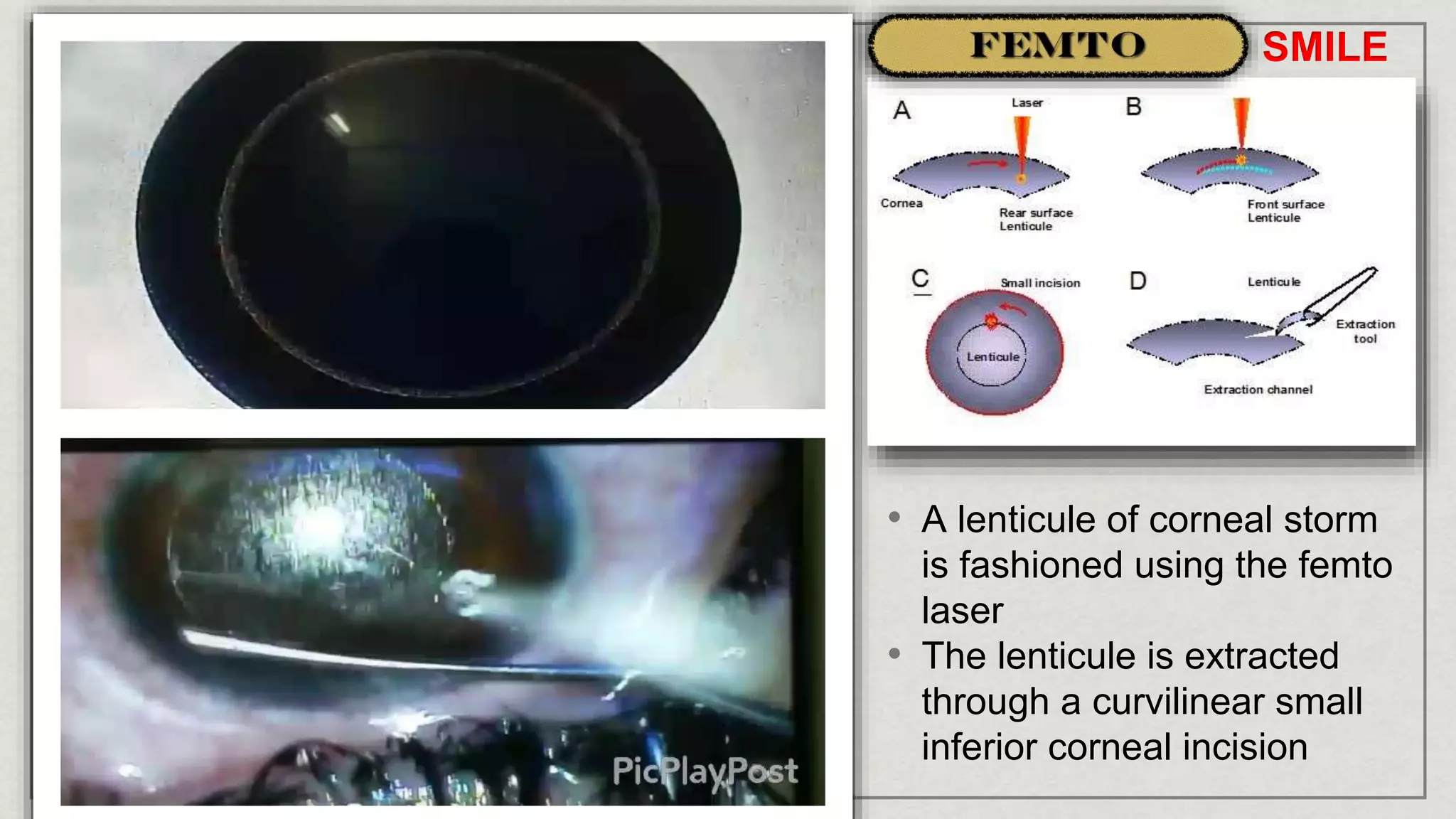• A lenticule of corneal storm
is fashioned using the femto
laser
• The lenticule is extracted
through a curvilinear small
inferior corneal incision
SMILE
 