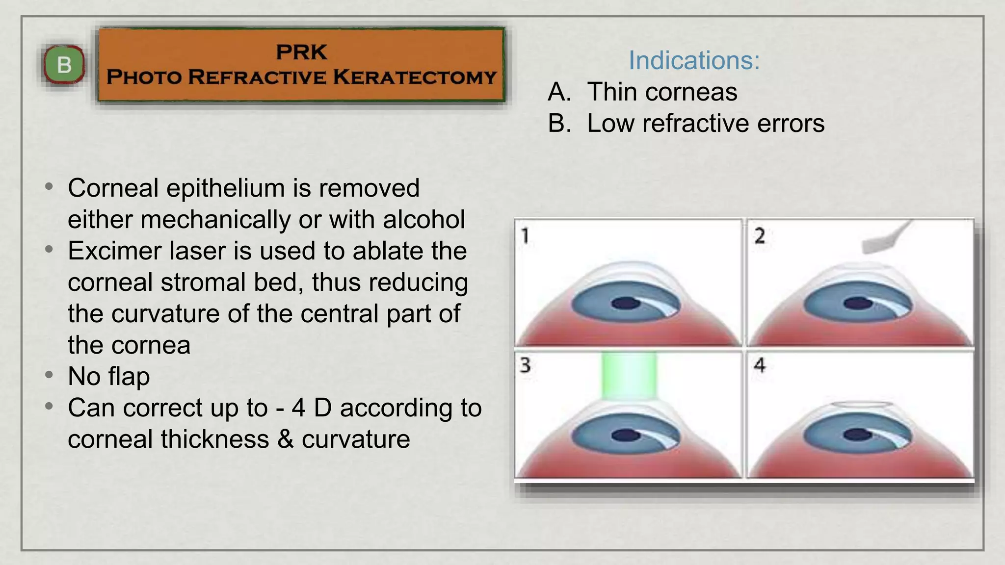Indications:
A. Thin corneas
B. Low refractive errors
• Corneal epithelium is removed
either mechanically or with alcohol
• Excimer laser is used to ablate the
corneal stromal bed, thus reducing
the curvature of the central part of
the cornea
• No flap
• Can correct up to - 4 D according to
corneal thickness & curvature
 