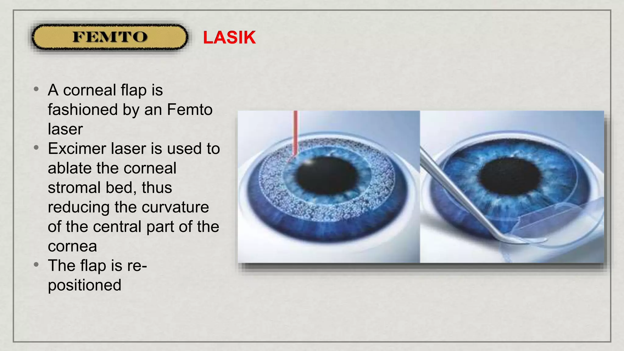 • A corneal flap is
fashioned by an Femto
laser
• Excimer laser is used to
ablate the corneal
stromal bed, thus
reducing the curvature
of the central part of the
cornea
• The flap is re-
positioned
LASIK
 