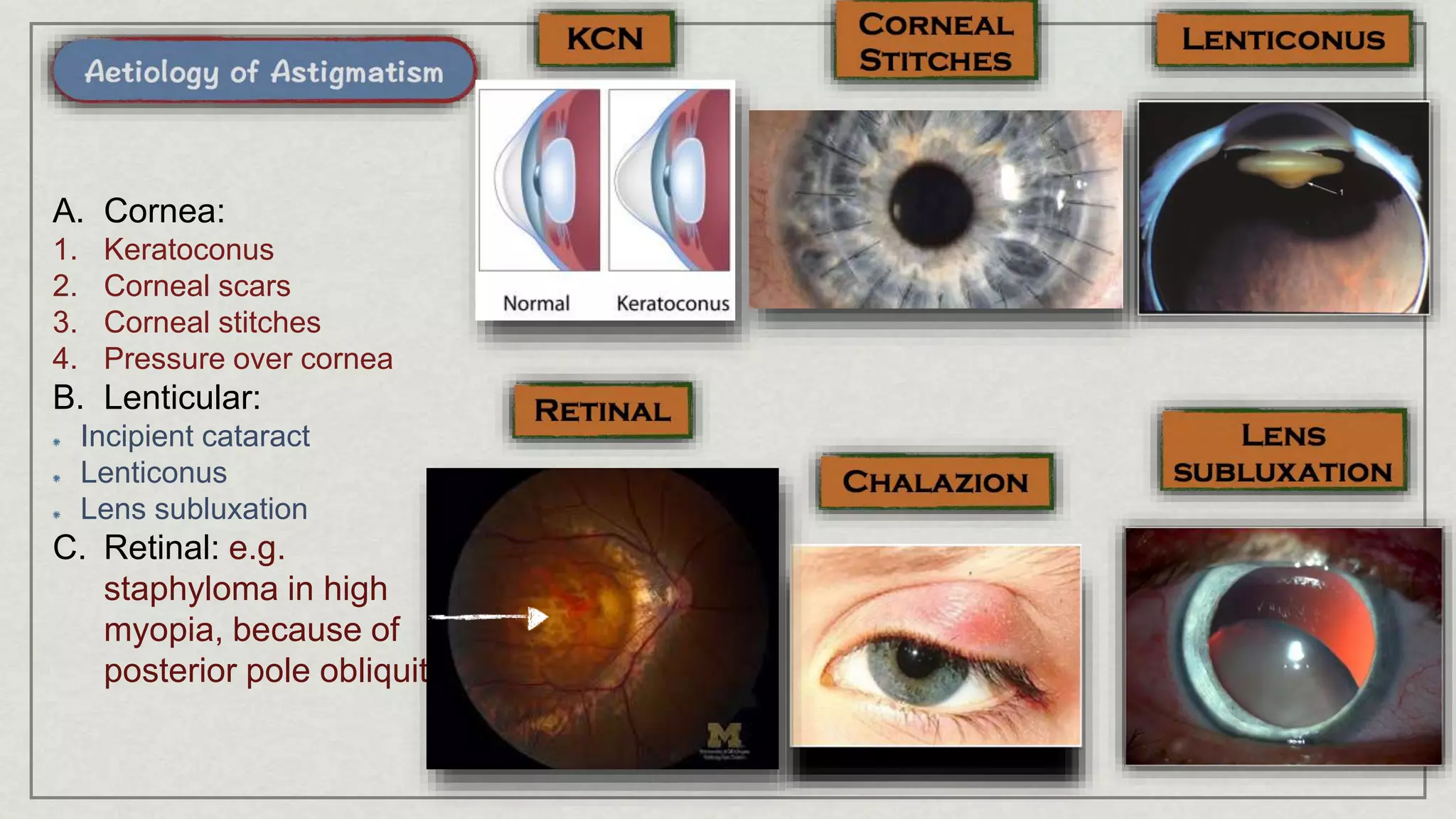 A. Cornea:
1. Keratoconus
2. Corneal scars
3. Corneal stitches
4. Pressure over cornea
B. Lenticular:
Incipient cataract
Lenticonus
Lens subluxation
C. Retinal: e.g.
staphyloma in high
myopia, because of
posterior pole obliquity
 