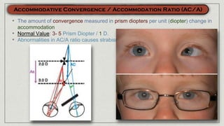 • The amount of convergence measured in prism diopters per unit (diopter) change in
accommodation
• Normal Value: 3- 5 Prism Diopter / 1 D.
• Abnormalities in AC/A ratio causes strabismus
 