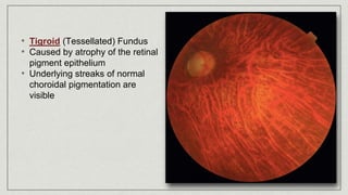 • Tigroid (Tessellated) Fundus
• Caused by atrophy of the retinal
pigment epithelium
• Underlying streaks of normal
choroidal pigmentation are
visible
 