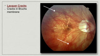 • Lacquer Cracks
Cracks in Bruchs
membrane
 