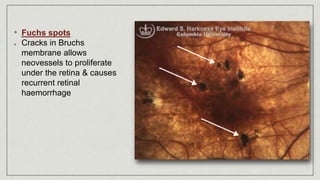 • Fuchs spots
Cracks in Bruchs
membrane allows
neovessels to proliferate
under the retina & causes
recurrent retinal
haemorrhage
 