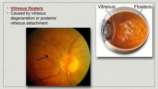 • Vitreous floaters
• Caused by vitreous
degeneration or posterior
vitreous detachment
 