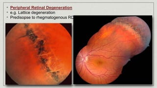 • Peripheral Retinal Degeneration
• e.g. Lattice degeneration
• Predisopse to rhegmatogenous RD
 