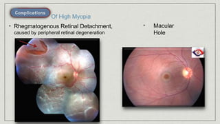 • Rhegmatogenous Retinal Detachment,
caused by peripheral retinal degeneration
Of High Myopia
• Macular
Hole
 
