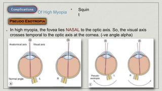 • Squin
t
Of High Myopia
In high myopia, the fovea lies NASAL to the optic axis. So, the visual axis
crosses temporal to the optic axis at the cornea. (-ve angle alpha)
 