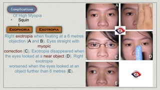 • Squin
t
Of High Myopia
Right exotropia when fixating at a 6 metres
objection (A and B). Eyes straight with
myopic
correction (C). Exotropia disappeared when
the eyes looked at a near object (D). Right
exotropia
worsened when the eyes looked at an
object further than 6 metres (E).
 