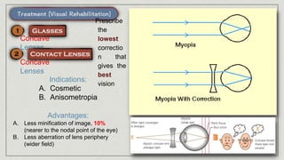 Concave
Lenses
Concave
Lenses
Indications:
A. Cosmetic
B. Anisometropia
Advantages:
A. Less minification of image, 10%
(nearer to the nodal point of the eye)
B. Less aberration of lens periphery
(wider field)
Prescribe
the
lowest
correctio
n that
gives the
best
vision
 