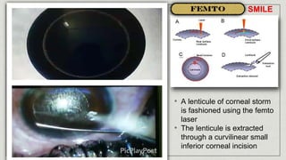 • A lenticule of corneal storm
is fashioned using the femto
laser
• The lenticule is extracted
through a curvilinear small
inferior corneal incision
SMILE
 