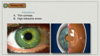 Indications:
A. Thin corneas
B. High refractive errors
 