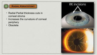 • Radial Partial thickness cuts in
corneal stroma
• Increases the curvature of corneal
periphery
• Obsolete
 