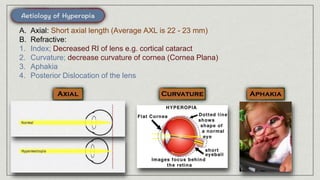 A. Axial: Short axial length (Average AXL is 22 - 23 mm)
B. Refractive:
1. Index; Decreased RI of lens e.g. cortical cataract
2. Curvature; decrease curvature of cornea (Cornea Plana)
3. Aphakia
4. Posterior Dislocation of the lens
 