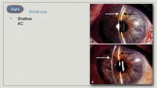 • Shallow
AC
Small eye
 